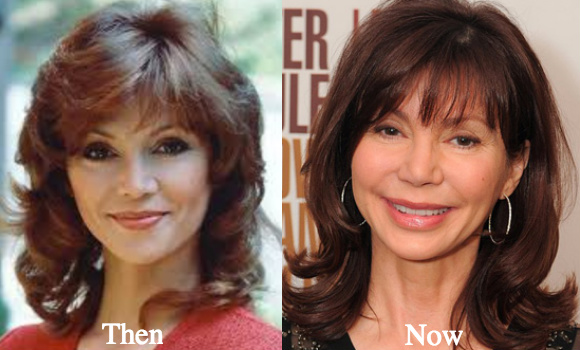 victoria-principal-plastic-surgery-before-and-after