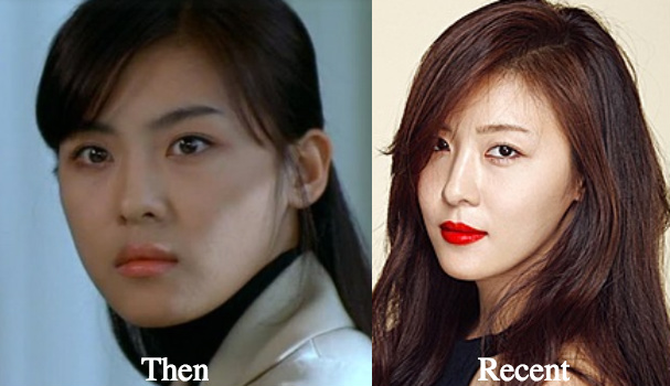 ha-ji-won-facial-fillers-before-and-after