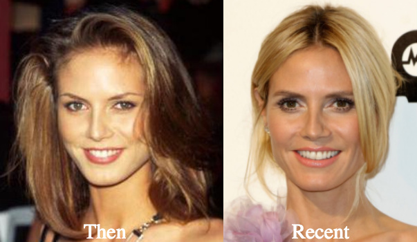 heidi-klum-botox-before-and-after