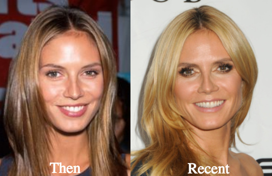 heidi-klum-nose-job-before-and-after