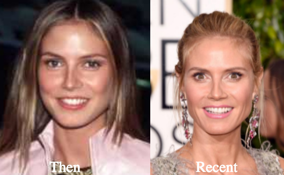 heidi-klum-plastic-surgery-before-and-after-photos