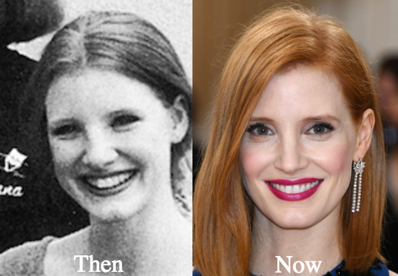 jessica-chastain-rhinoplasty-before-and-after