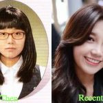 Jung Eun Ji Plastic Surgery Before and After Photos