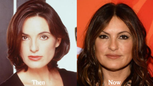 Mariska Hargitay Plastic Surgery Before And After Photos Latest 