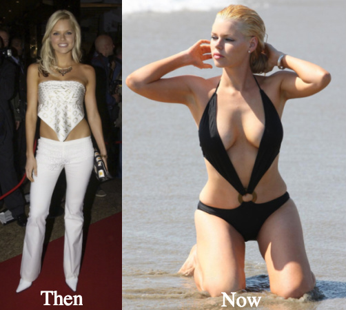 sophie-monk-breast-implants-before-and-after