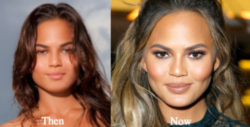 Chrissy Teigen Plastic Surgery Before And After Photos