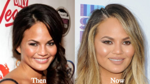 Chrissy Teigen Plastic Surgery Before And After Photos Latest Plastic Surgery Gossip And News 
