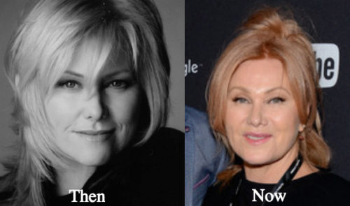 deborra lee furness plastic surgery Image 2