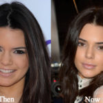 Kendall Jenner Plastic Surgery Lip Fillers Before and After Photos