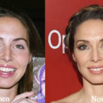 Whitney Cummings Plastic Surgery Before and After Photos