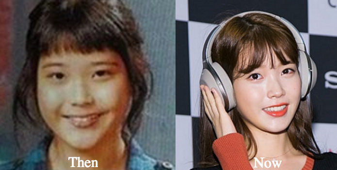 Iu Nose job Rumors before and after