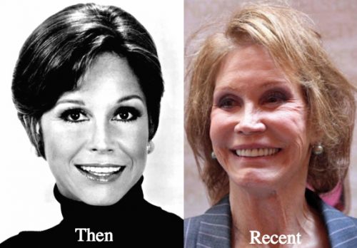 Mary Tyler Moore Plastic Surgery Before And After Photos Latest Plastic Surgery Gossip And 5202