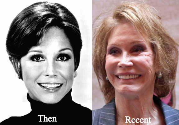 Mary Tyler Moore Plastic Surgery Before and after Photos