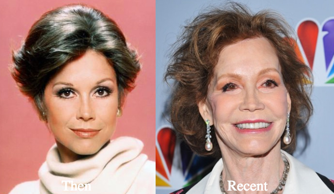 mary tyler moore cheek fillers and lift before and after