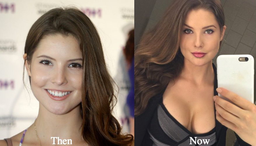 Amanda Cerny Lip Fillers before and after
