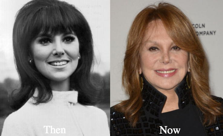 Marlo Thomas Botox injections before and after