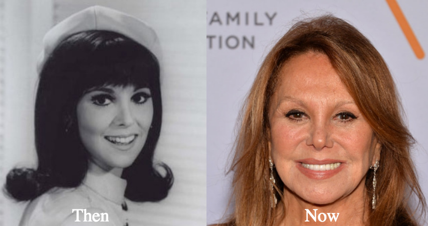 Marlo Thomas eyelid surgery brow lift before and after