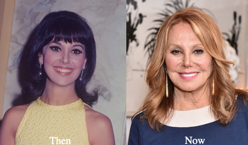 Marlo Thomas Plastic Surgery Before and After Photos