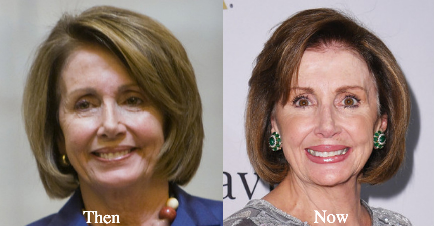 Nancy facial