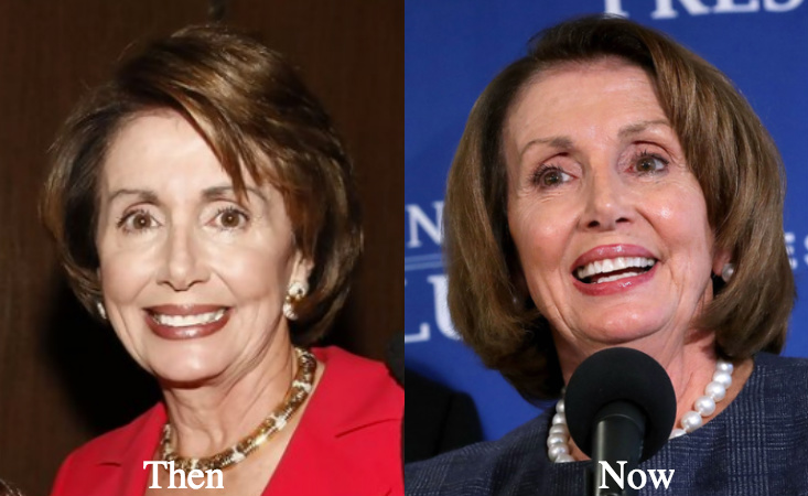 nancy pelosi plastic surgery before and after photos