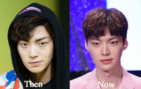 Ahn Jae Hyun Lip Fillers before and after photos