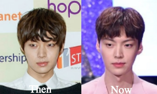 Ahn Jae Hyun eyelid surgery before and after photos