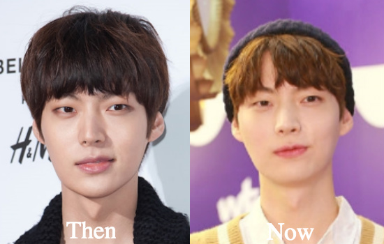 Ahn Jae Hyun nose job before and after photos