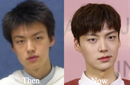 Ahn Jae Hyun plastic surgery before and after photos
