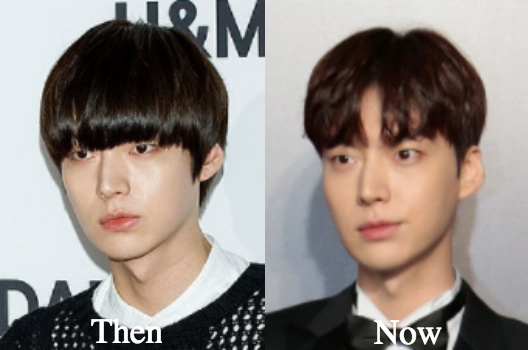 Ahn Jae Hyun rhinoplasty before and after