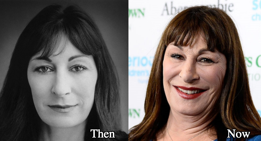Anjelica Huston plastic surgery before and after