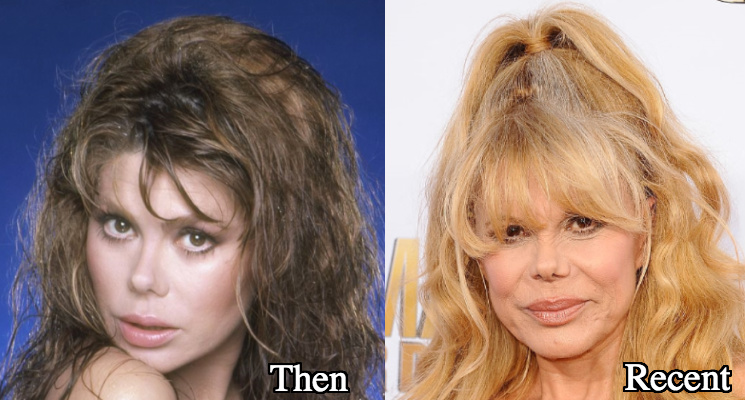 Charo Eyelid Surgery before and after photos
