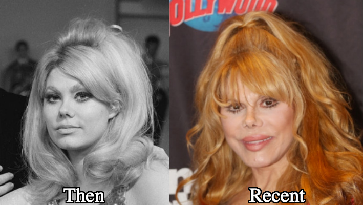 Charo Facelift before and after photos