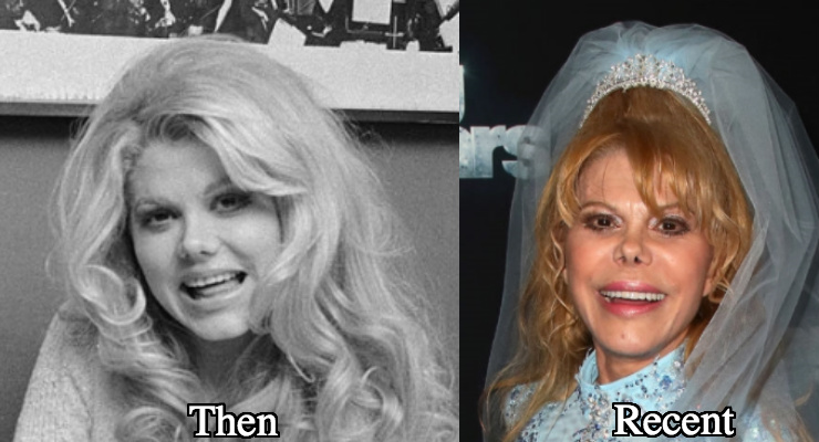 Charo Nose job before and after photos
