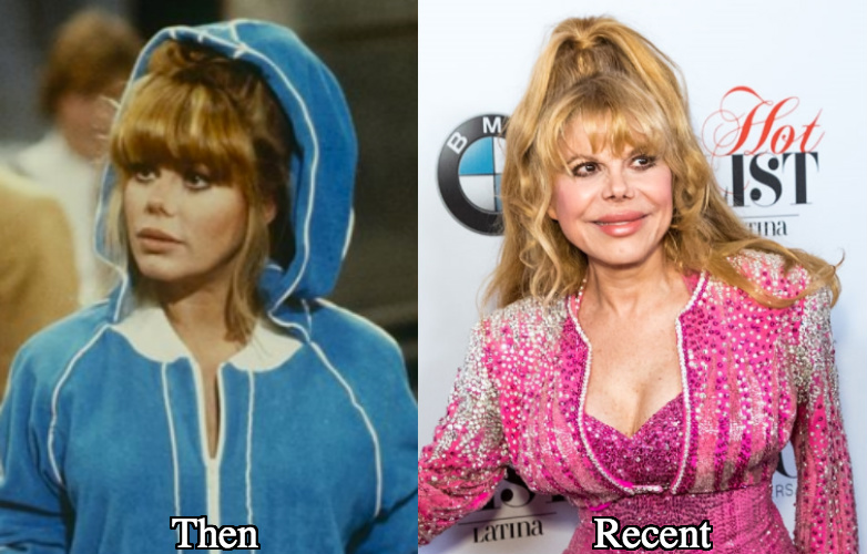 Charo breast augmentation before and after photos