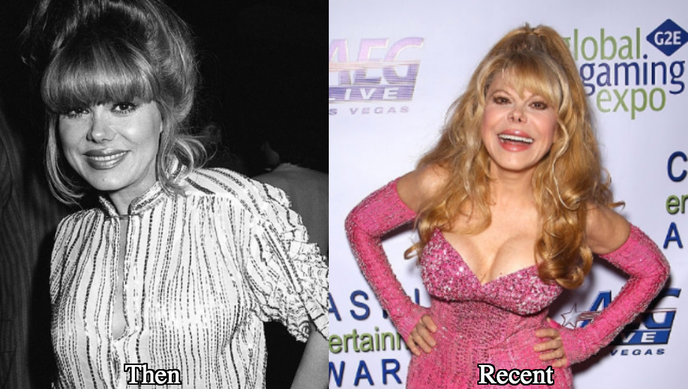 Charo breast implants surgery before and after