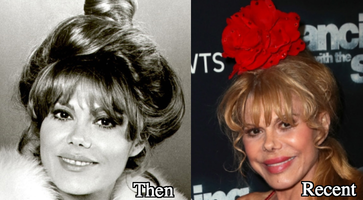 Charo facial fillers before and after
