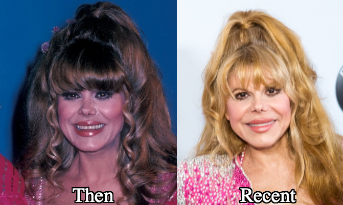 Charo lip implants fillers before and after photos