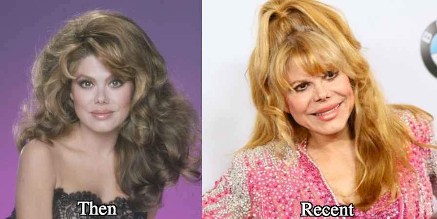Charo plastic surgery before and after photos