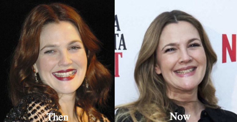 Drew Barrymore facial fillers before and after