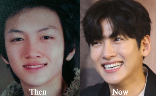 Ji Chang Wook rhinoplasty before and after