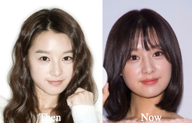 Kim Ji Won Rhinoplasty before and after