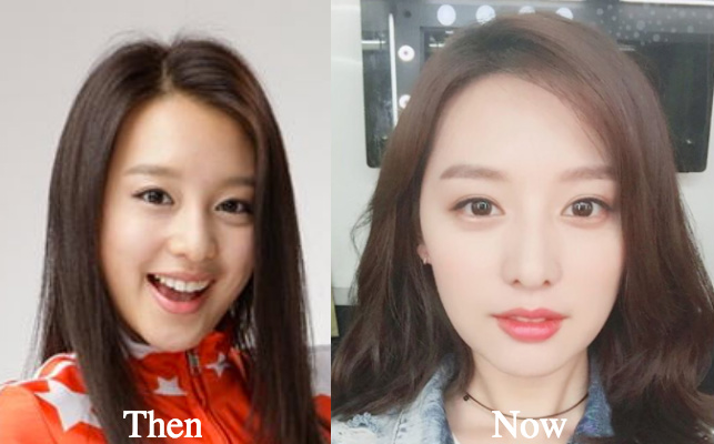 Kim Ji Won eyelid surgery before and after