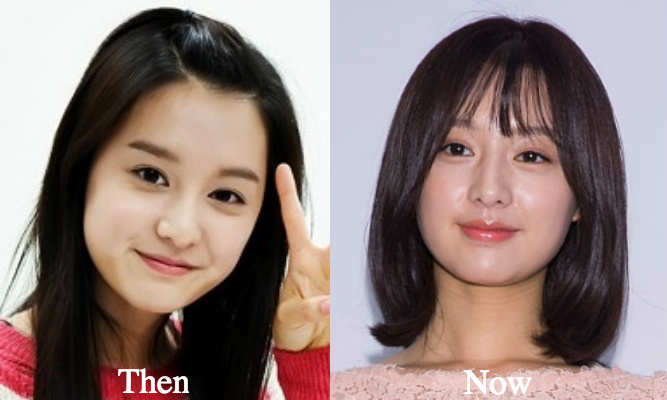 Kim Ji Won facial fillers before and after