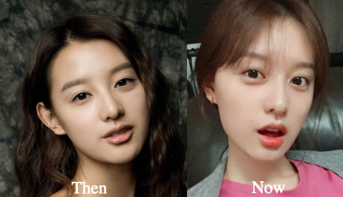 Kim Ji Won nose job before and after