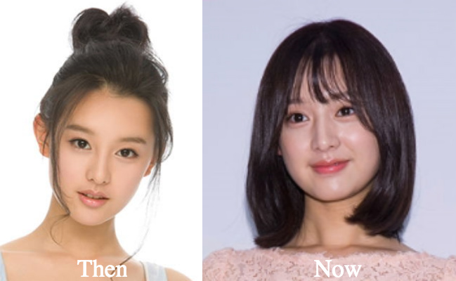 Kim Ji Won plastic surgery before and after photos