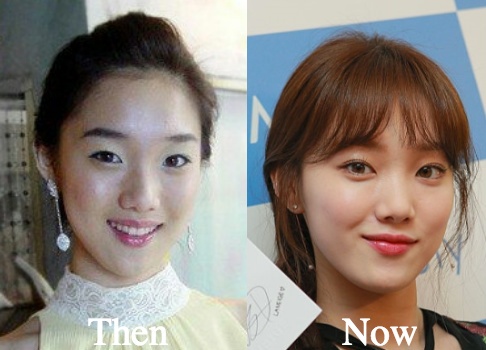 Lee Sung Kyung double eyelid surgery before and after