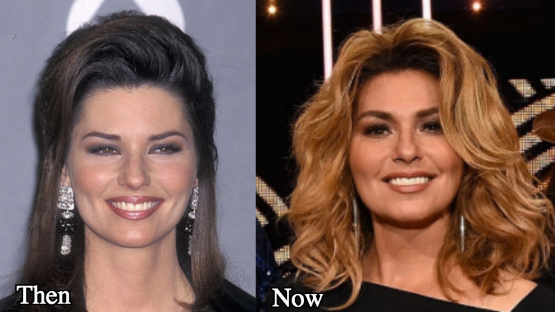 Shania Twain botox injections before and after