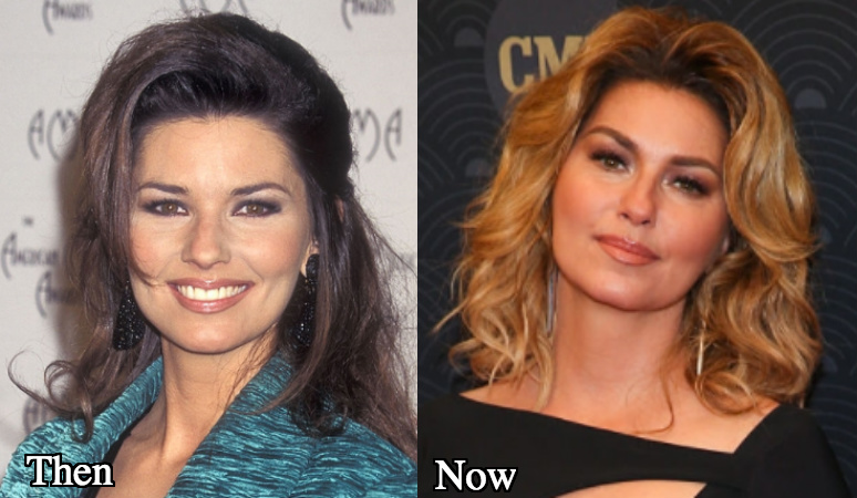 Shania Twain cheek fillers rumors before and after