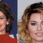 Shania Twain Plastic Surgery Before and After Photos