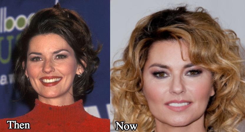 Shania Twain plastic surgery before and after photos